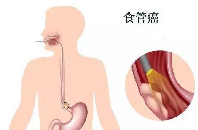 食道癌最新治療方法的研究進(jìn)展與臨床應(yīng)用