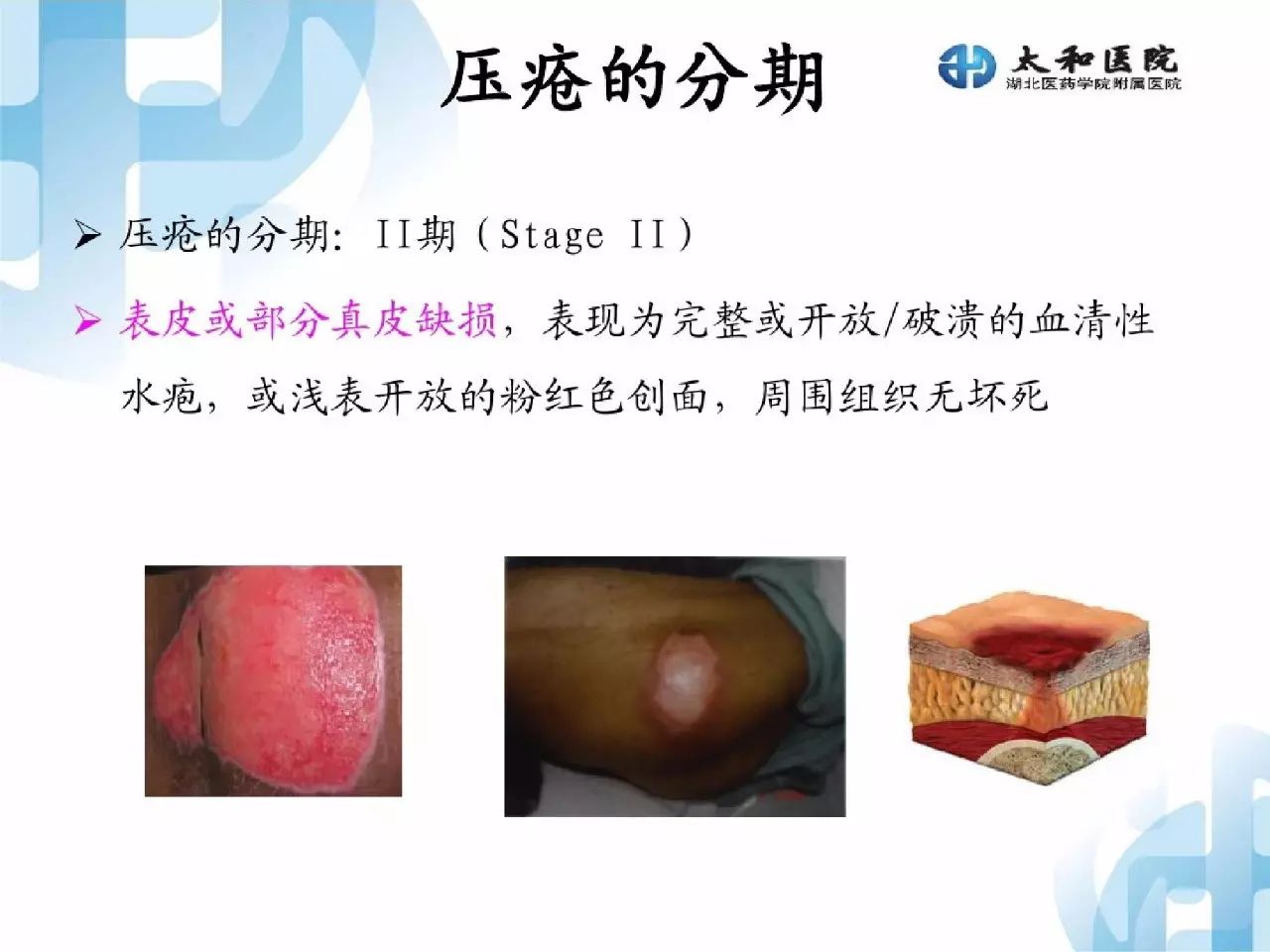 最新壓瘡定義，深化理解與提升護(hù)理策略